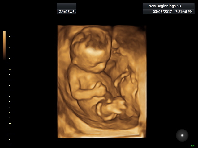 15 Weeks Pregnant 4d Ultrasound Gender - pixaby