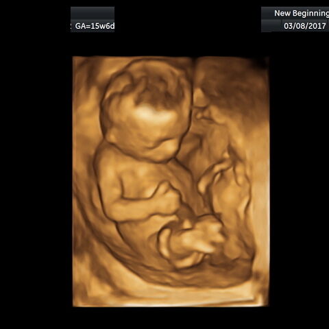 3D ultrasound image of a fetus inside the womb.