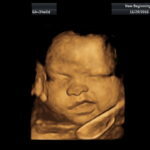3D ultrasound image of a baby's face in the womb.